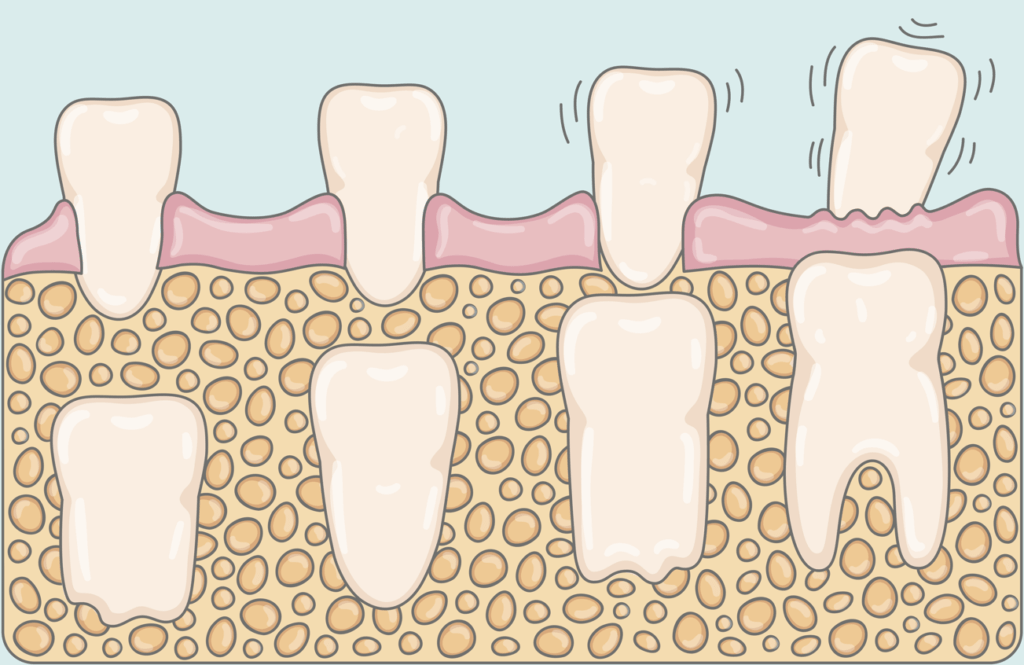 dents-de-lait-qui-tombent