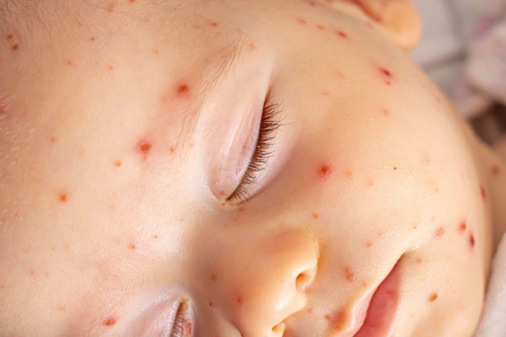 comment-soigner-la-varicelle-dun-enfant