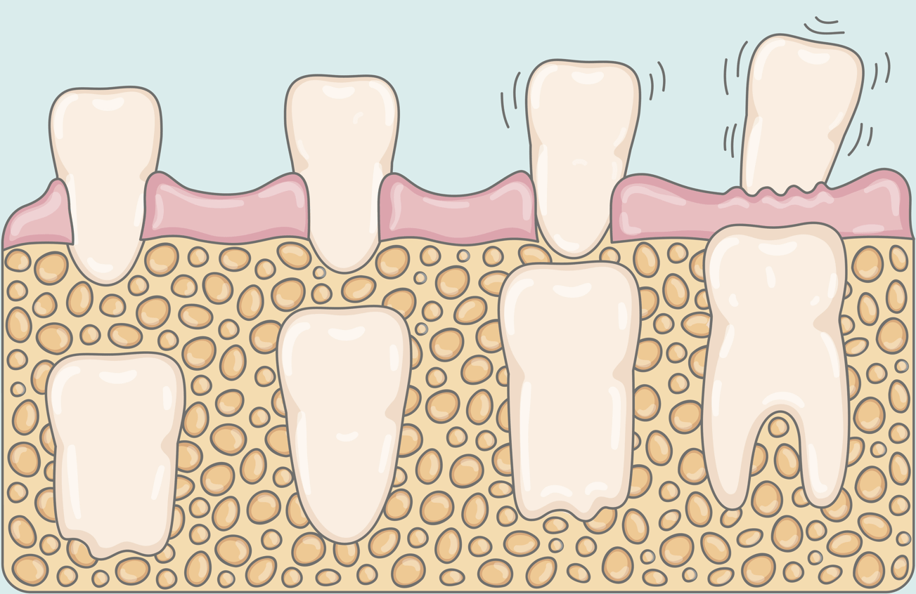 Les dents définitives de mon enfant poussent derrière ses dents de lait, que faire